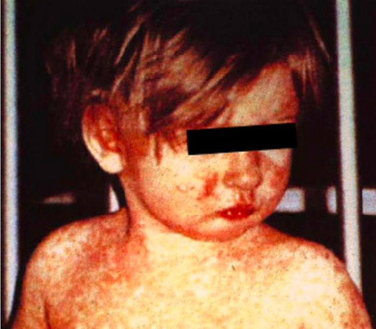 The true dollar cost of the anti-vaccine movement