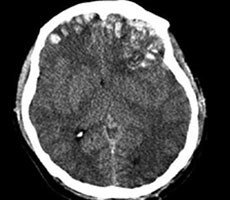 Terrifying Malware Alters CT Scans To Look Like Brain Cancer, Fools Radiologists