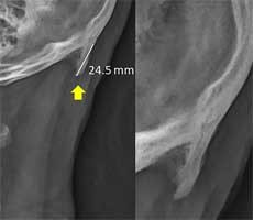 Researchers Say Horns Are Growing In The Back Of Human Skulls Due To Cellphones