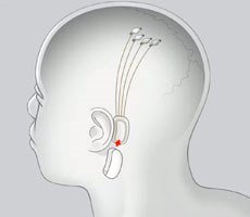 Elon Musk Unveils Neuralink Human-Brain Interface Straight Out Science Fiction