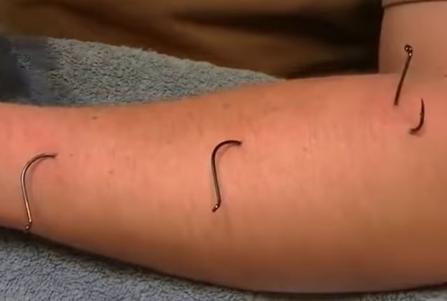 how-to-remove-fish-hooks-from-skin.jpg