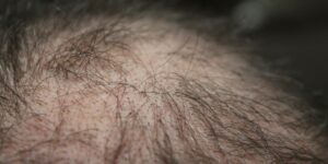 Hair Man Hair Loss Head