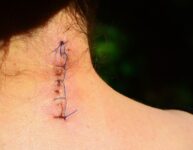 Intervertebral Disc Surgery Wound Seam Sewn