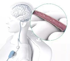 Synchron's Brain Implant Breakthrough Lets Users Control iPhones And iPads With Their Mind