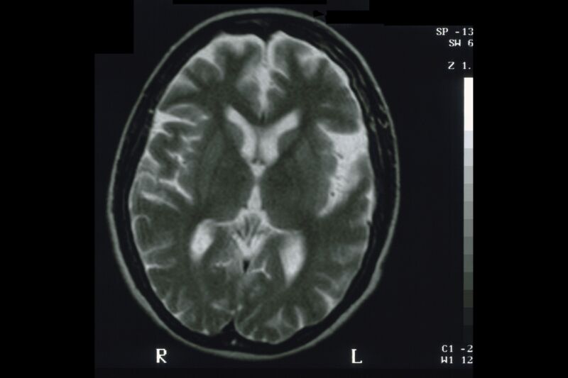 MRI of a human brain.