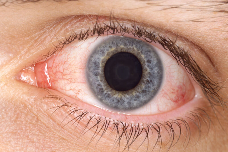 An inflamed eye.