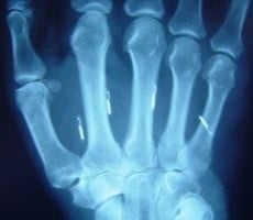 Engineer Implants 25 Chips Under Her Skin To Unlock Doors And Other Cool Party Tricks